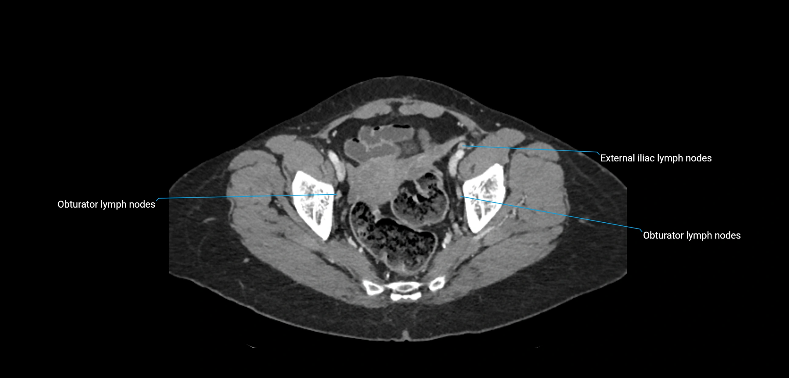 CT ct abdominal lymph nodes  axial cross sectional anatomy  enchanced radiology image -img-00002-00366.webp